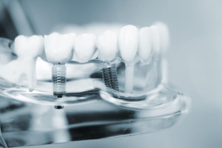 Dental Implants 768x512