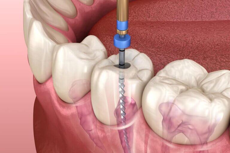 Root Canal Treatment 768x512