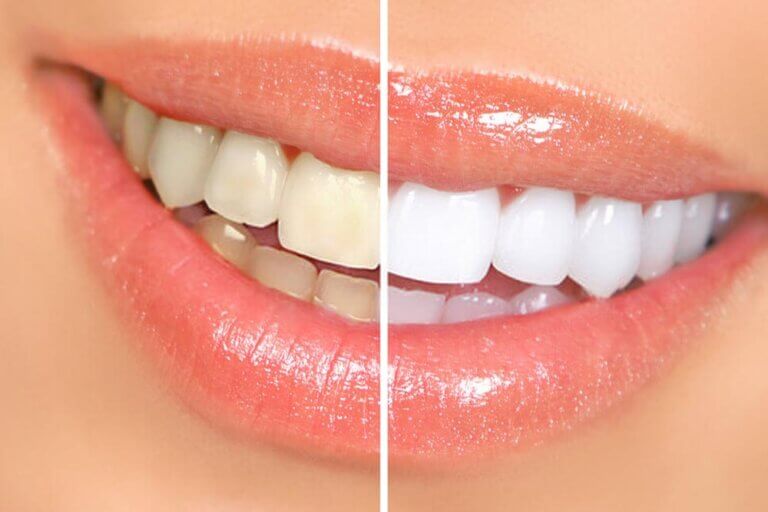 Teeth Whitening 768x512
